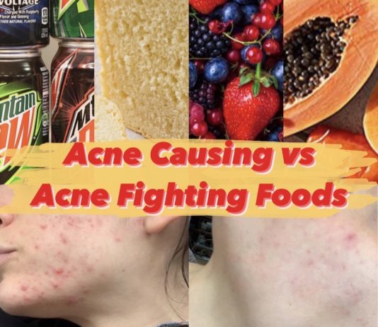 acne fighting foods